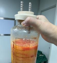 伊犁水动力吸脂手术要做多久？